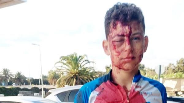 Itay Cohen with a bloodied face